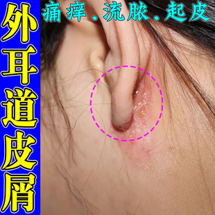 耳朵外耳道皮屑燥起皮耳道痒软膏药
