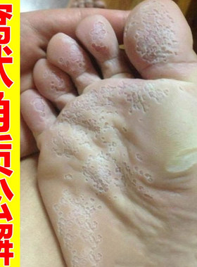 窝状角质松解症药脚底起泡蜂窝状沙虫脚脚底脚掌发白喷雾剂