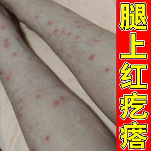 蚊虫叮咬疙瘩腿上痒起红点痒外用药身上痒起红疙瘩小腿痒外用软膏