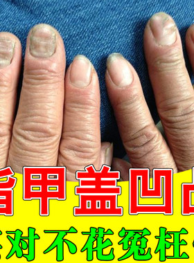 指甲盖凹凸不平整儿童成人营养不良甲床受损竖纹变坑洼修复
