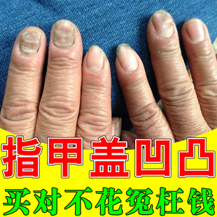 指甲盖凹凸不平整儿童成人营养不良甲床受损竖纹变坑洼修复
