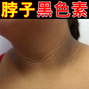 脖子黑春夏天气热身上皮肤晒黑儿童黑棘皮膝盖关节手肘黑色素沉淀