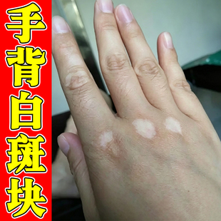 手背长白斑儿童成人肤色不均色素脱失补骨脂酊促进黑色素生长