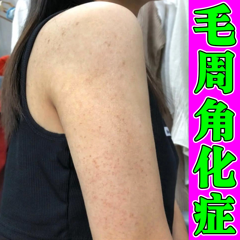 手臂鸡皮肤疙瘩毛周角化症药毛囊堵塞长粗糙颗粒干燥痒外用修复膏
