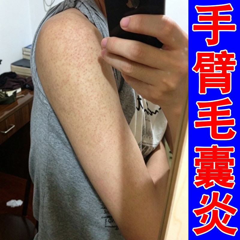手臂毛囊堵塞毛周角化症粗糙干燥长小黑点疙瘩摸起来粗糙修复软膏