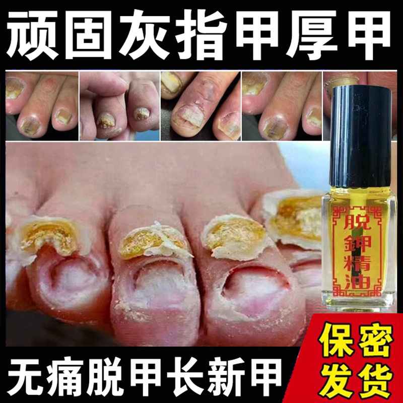 玉指露脱甲精油无痛脱甲液灰指甲脱甲膏脚指甲软化剂抑菌液专用液