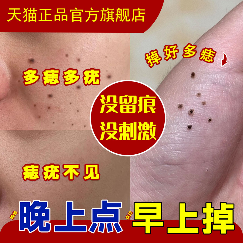 点痣膏正品祛斑点痣药水无痕神器不留疤修复液克疣去痔官方旗舰bx