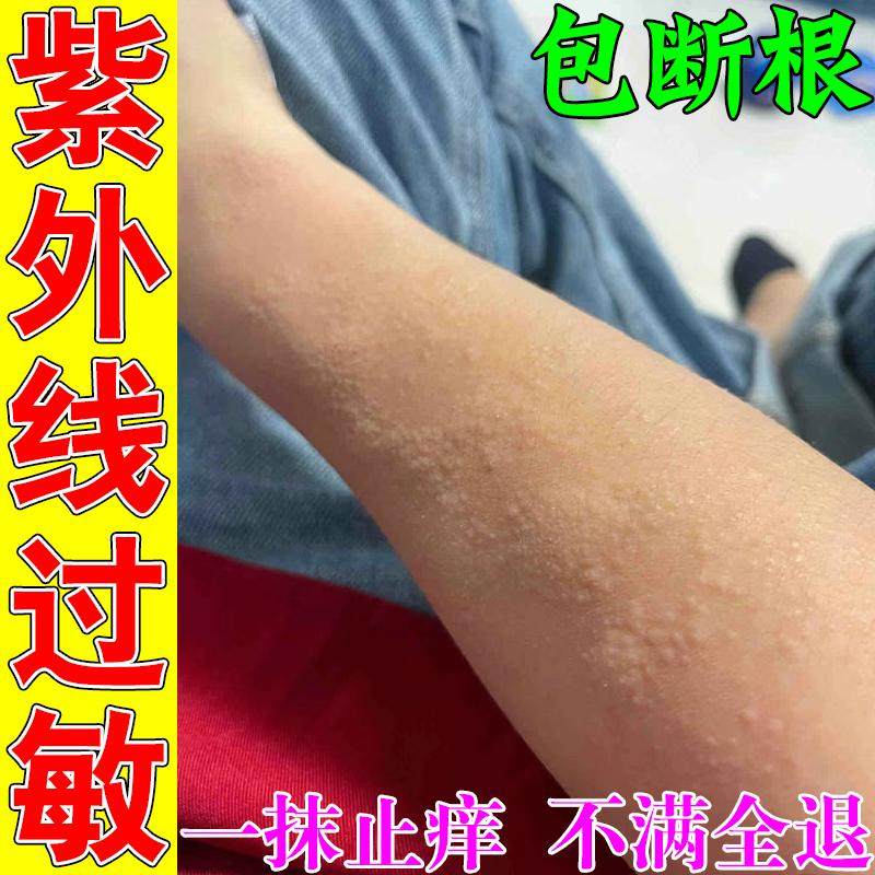 治疗紫外线过敏日光神经性皮炎根去外用顽固无激素晒伤过敏修复药