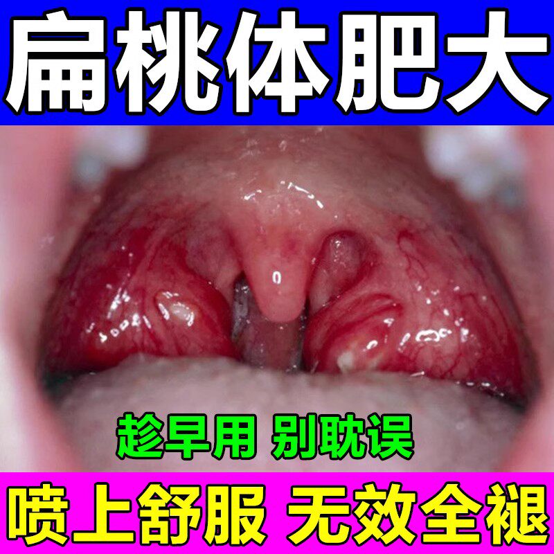 玺锦堂成人扁桃体肥大肿大贴治疗扁桃体肥大打鼾调理药口腔喷雾剂