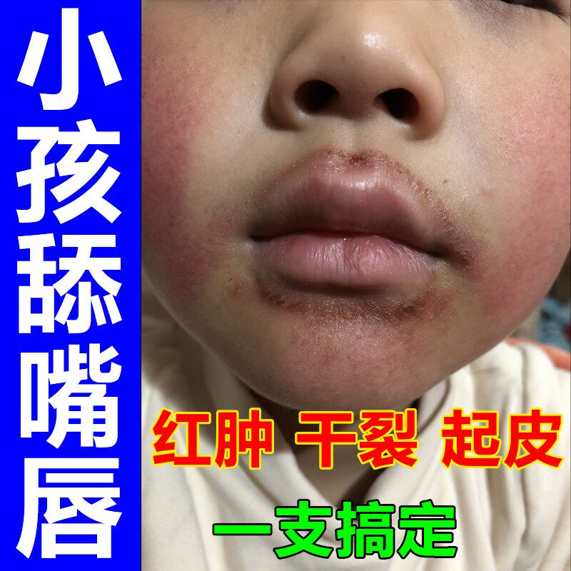 唇炎专用y膏修护用唇膏嘴唇干裂脱皮维生素儿童嘴角干燥起皮开裂