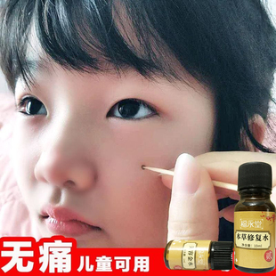 取点脸部痕正品祛神器斑药痣雀黑点美容院专用水净无去膏笔痦子