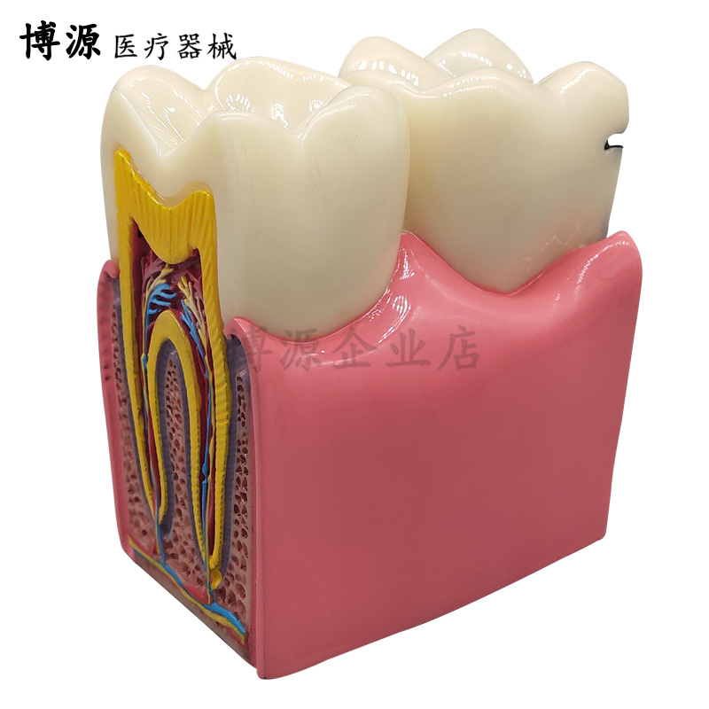 牙科 牙齿模型 6倍龋齿对比模型 口腔模型 医患沟通教学模型包邮