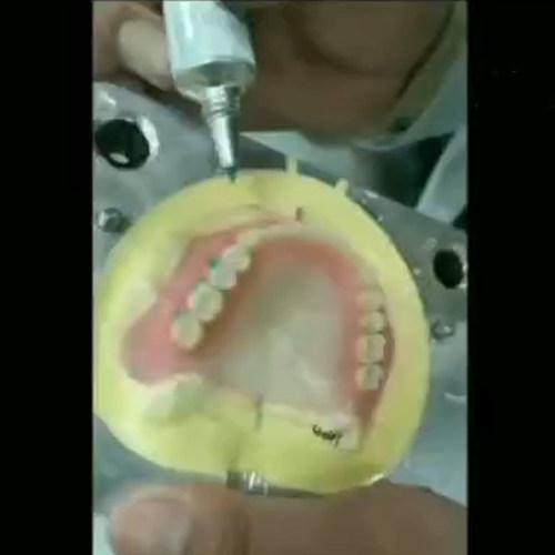 牙科材料 新世纪光固化固位胶 全口吸附性义齿注塑冲胶固位胶