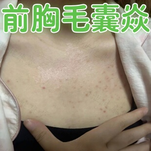 前胸长痘后背毛囊焱痒止药后背身上过敏有马拉色菌性外用软膏