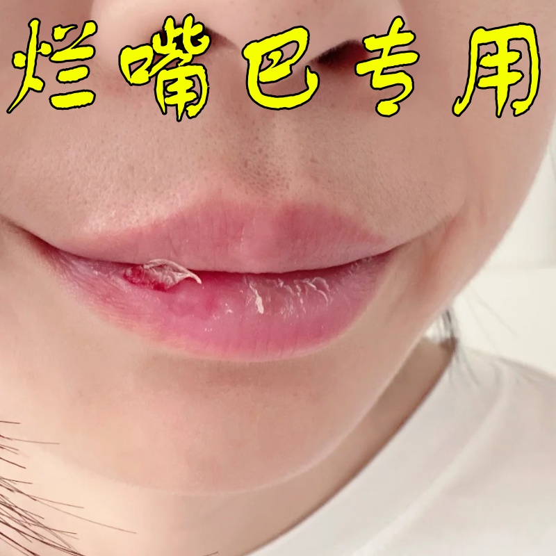 唇焱唇膏嘴巴红肿嘴唇上长疱诊干裂起皮起水泡红痒脱皮口周唇部炎