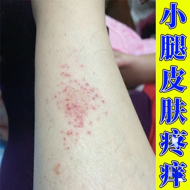 小腿痒药秋冬换季腿痒小腿皮肤疹干燥痒湿痒冬天身上痒药外用,洗护清洁剂/卫生巾/纸/香薰,身体乳液,淘宝优惠券,粉丝福利购,淘宝优惠卷