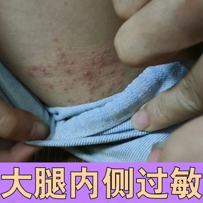 大腿内侧皮肤过敏痒股藓专用大腿根红肿屁股湿痒疹慢性真菌感染药
