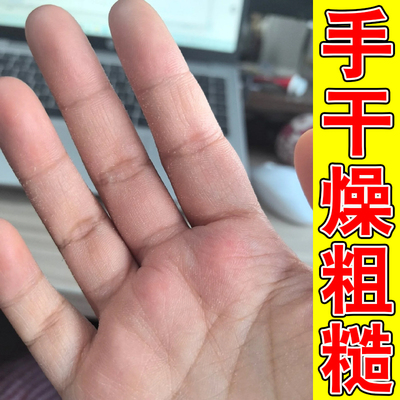 手干手起皮手蜕皮脚干燥裂口粗糙起皮屑去死皮