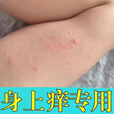 麻寻痒真菌性修复的药季节性皮肤身上起红疙瘩人工麻寻外用软膏