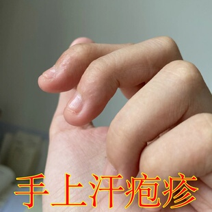 手上汗泡疹手指起水泡痒真菌汗状疹疱痒止膏手气膏鹅掌风水泡型药