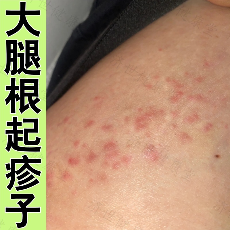 大腿内侧皮肤痒起疹子股藓真菌感染私处两侧红斑大腿根干燥脱皮药