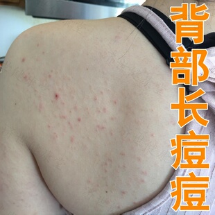 前胸痘痘毛囊角化过度痒止药身上皮肤炎堵塞毛孔长痘外用软膏