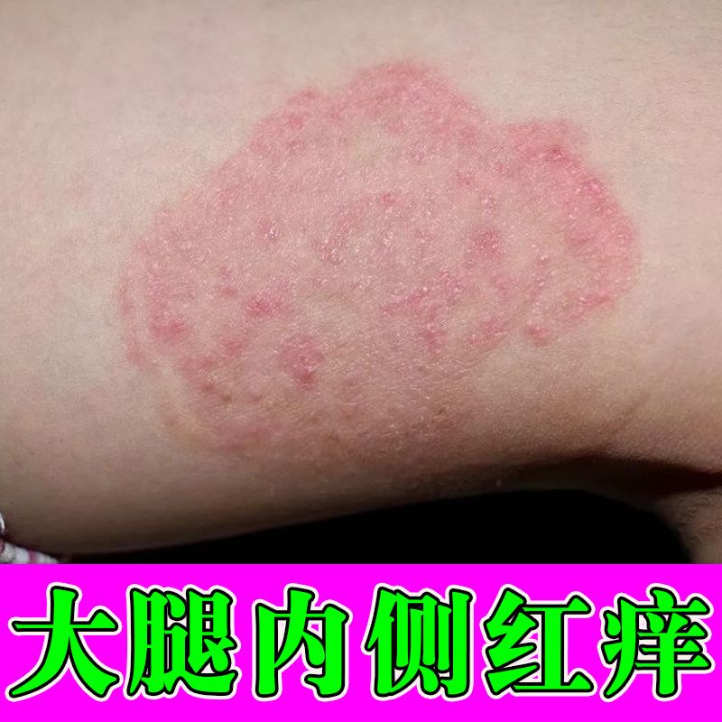 大腿内侧潮湿发痒大腿根两侧干痒长红斑起皮越挠越痒男女通用膏