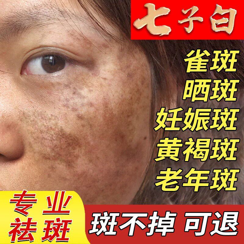 七子白祛斑霜祛黄褐斑老年斑去除