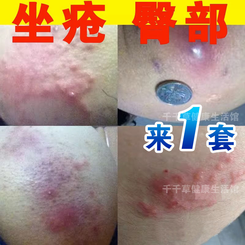 屁股痒坐疮膏屁股上长痘痘痒臀部缝座板疮痒皮肤好痒豆豆坐板仓