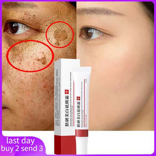 Whitening Freckle Cream Remove Melasma Cream Remove Dark Spo