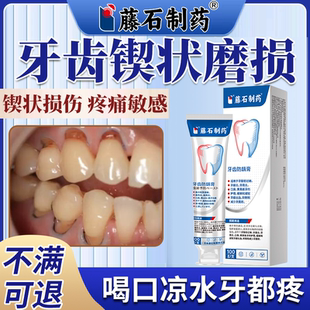 牙齿锲状磨损凝胶牙龈牙根牙釉质腐蚀松动敏感酸痛脱敏口腔疼痛PG