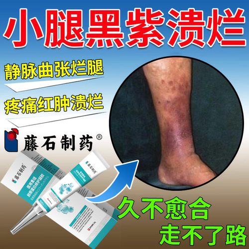 小腿下肢静脉曲张老烂腿专伤口愈合外用膏脉管炎发黑溃疡药监备PG