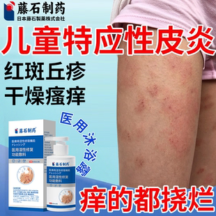 儿童特应性皮炎湿疹膏沐浴露泡澡止痒去皮肤瘙痒根药监备案PG