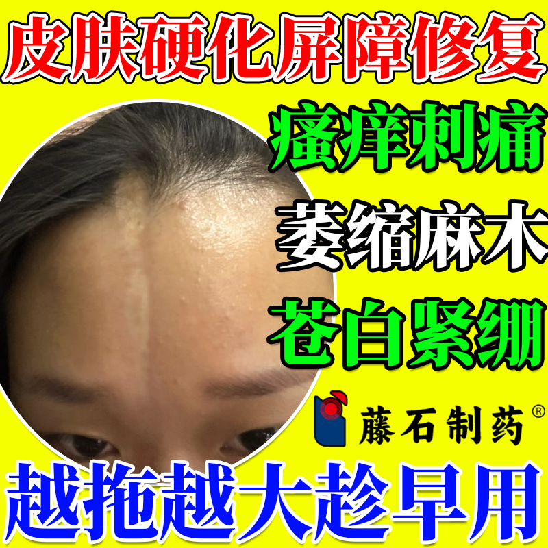 局限性硬皮病软膏硬皮症软化皮肤增厚萎缩手指硬皮癣药房同售PG