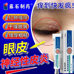 神经性皮炎眼皮癣膏眼睛周围眼角痒干燥起皮掉屑红肿痒药监备案PG