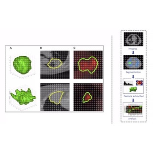 特征解析与提取 图像预处理 随机森林 ROI分割 影像组学