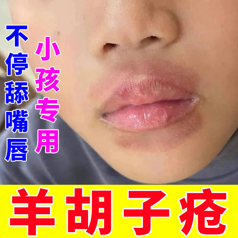 羊胡子疮嘴唇干裂脱皮维生素小孩舔嘴唇口周炎上火烂嘴角修护唇膏