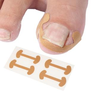 Ingrown Toenail Corrector Tool, Nail Correction Sticker for
