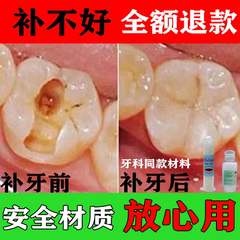 补牙神器自己在家补牙树脂填充剂蛀牙补牙齿洞膏补牙缝修复修补。_虎窝淘