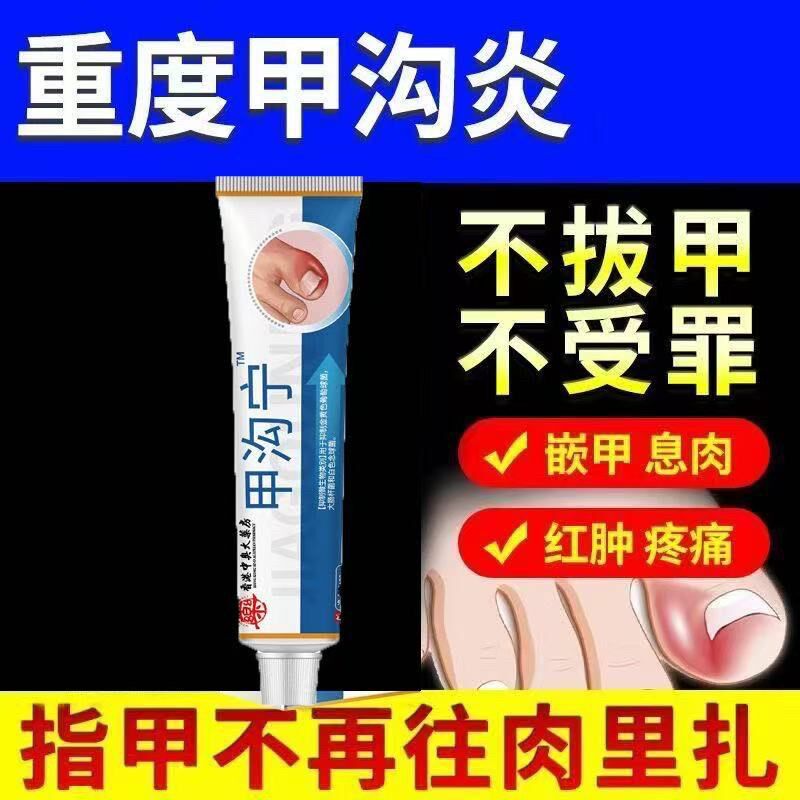 甲沟炎用药去肉芽脚趾甲往肉里长红肿疼痛化脓嵌甲息肉抑菌液