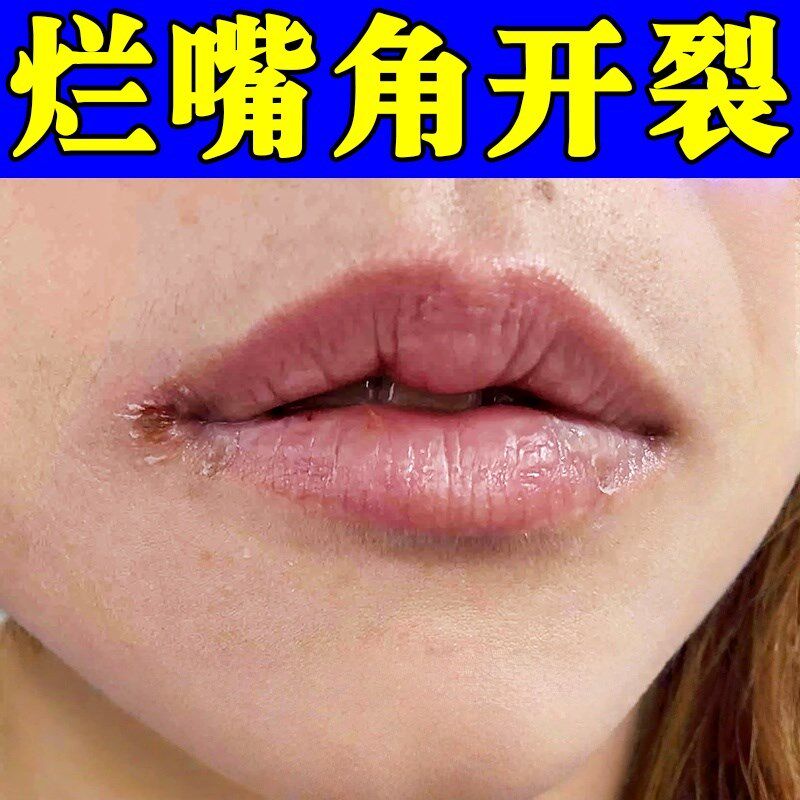 嘴角开裂烂嘴角膏嘴唇干裂起皮唇周/诊嘴角疱/炎起小水泡红肿痒膏