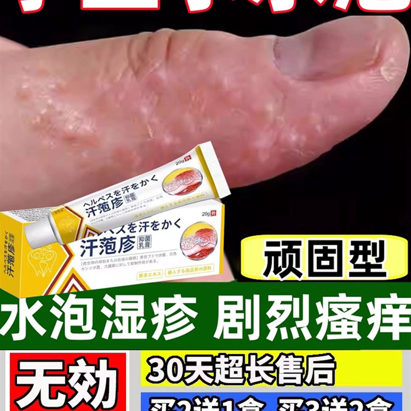 汗泡疱珍药手上起小水泡膏止痒汉汗状包疹专用真菌感染手气痒软膏