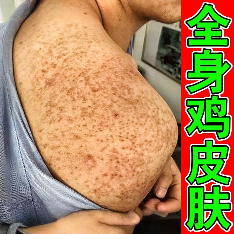 鸡皮肤疙瘩毛囊角化膏去除全身手臂腿小疙瘩毛孔堵塞角质皮肤霜