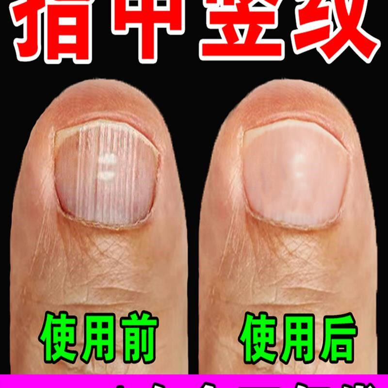指甲竖条纹修覆营养精华液油甲床分离空r甲修覆开裂薄软生长凹凸