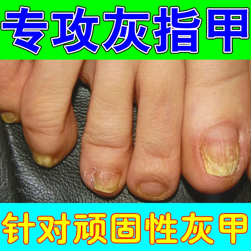 脱甲膏灰指甲专用快速去除手脚指甲钙化甲藓真菌感染甲床发黄浑浊