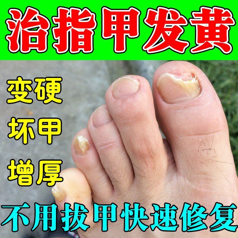 脚指甲发黄变厚变硬治真菌白甲空甲修复甲分离脱落软化营养抑菌液