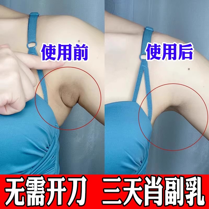 副乳淋巴贴去副乳神器【最慢3天收副乳】腋下淋巴疏通专用膏药贴
