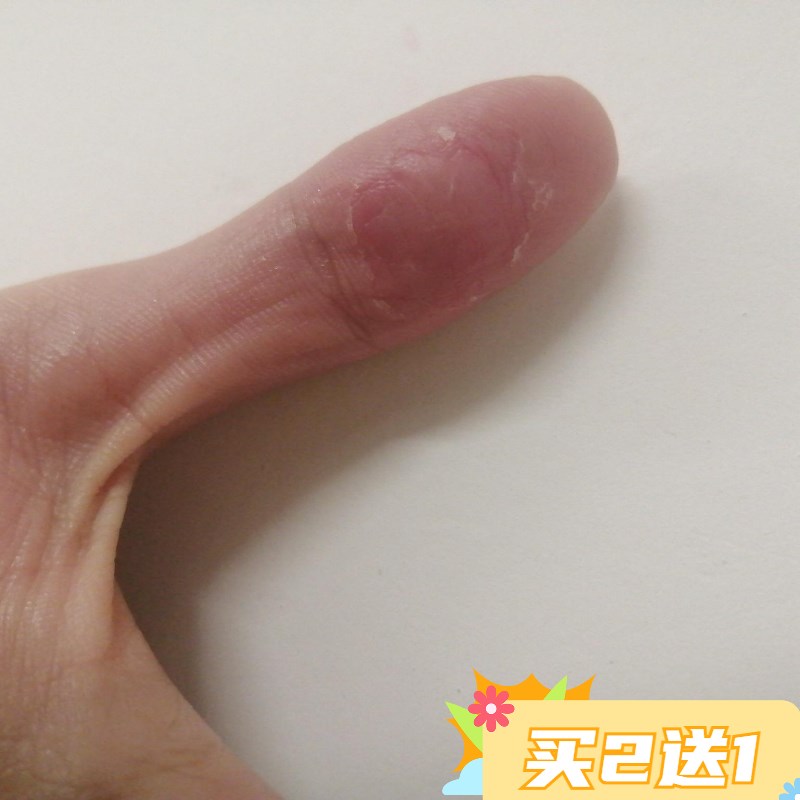 手痒水泡脱皮干裂手鲜膏手上起小水泡季节性手脱皮紫椒脚足酊痒膏