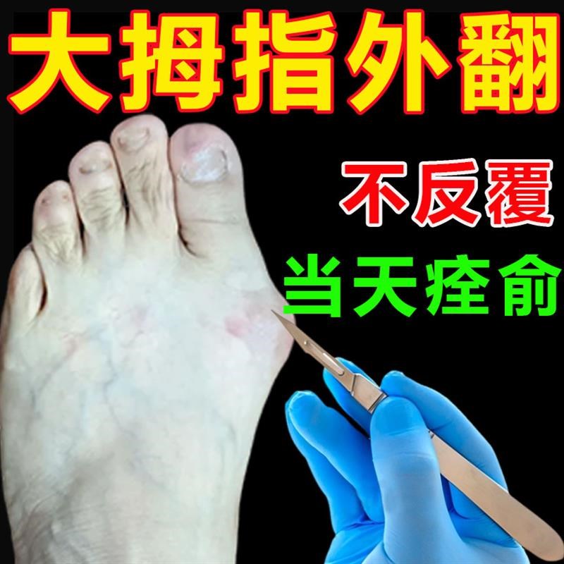 拇指外翻药膏贴大脚骨专用药脚趾重叠膏克星突出矫正器治疗拇囊炎