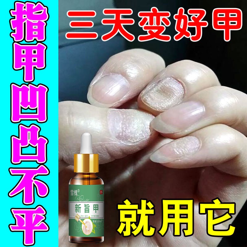 指甲凹凸不平修复液治疗甲床受损再生分离真菌感染开裂精华营养液